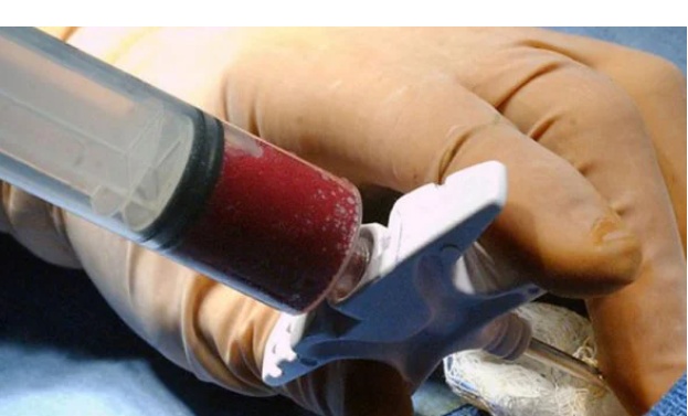 Cientistas conseguem curar paciente com HIV após transplante de células-tronco