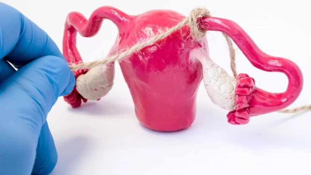 Lei que dispensa aval do cônjuge para realização da laqueadura ou vasectomia entra em vigor nesta quinta