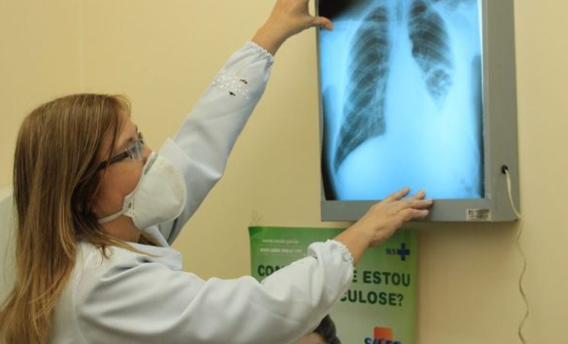 Governo cria comitê interministerial para atuar contra a tuberculose; Brasil concentra um terço dos casos da doença nas Américas