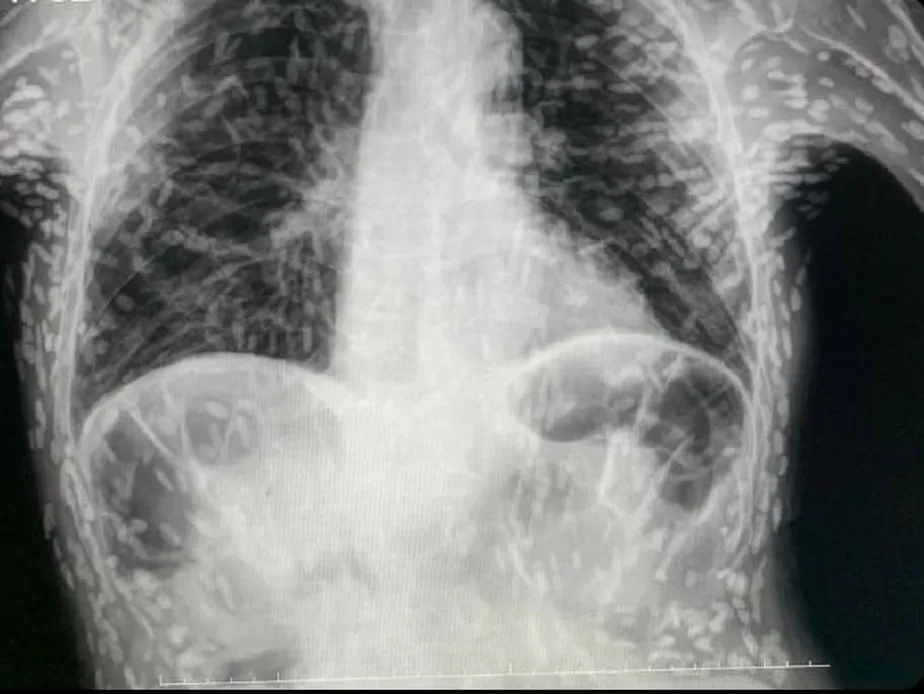 Imagem chocante de raio X mostra tórax de paciente repleto de ovos de tênia