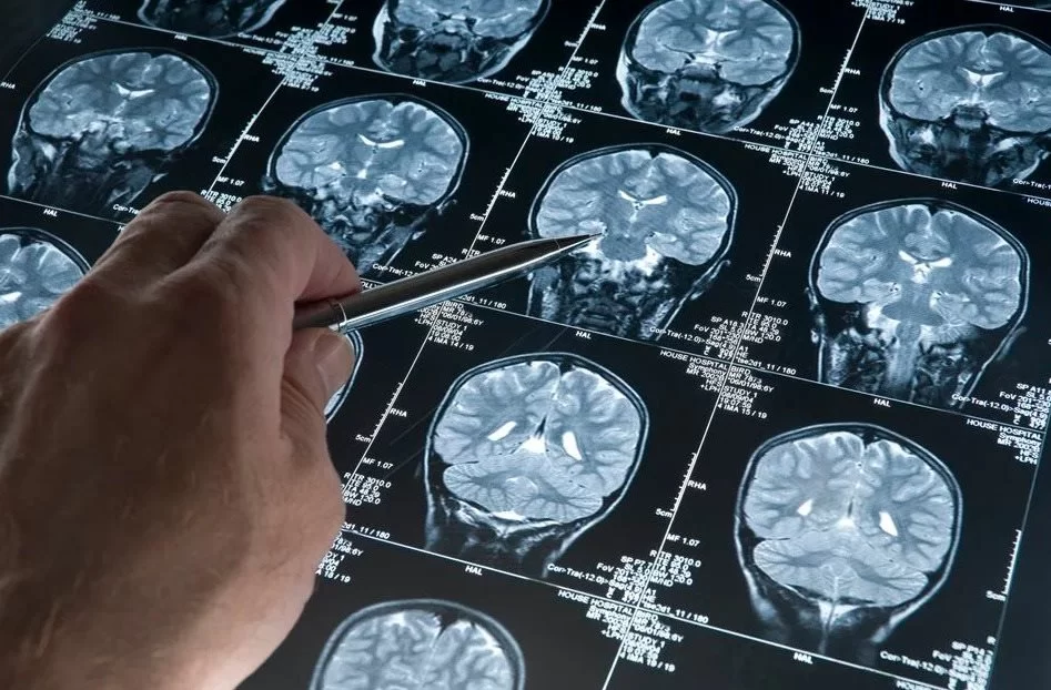 Estudo indica que Covid-19 acelera sintomas de demência, alzheimer e parkinson