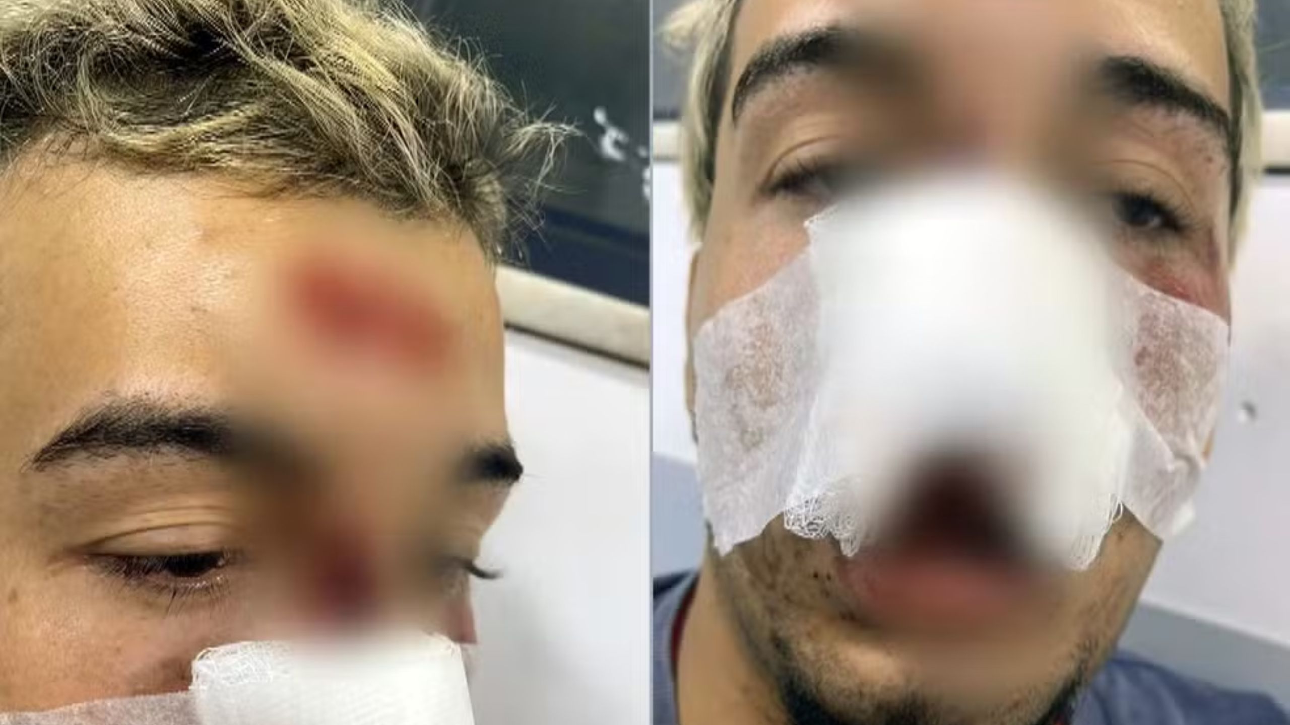 Ciclista perde dentes ao cair em buraco na ciclovia em Japeri