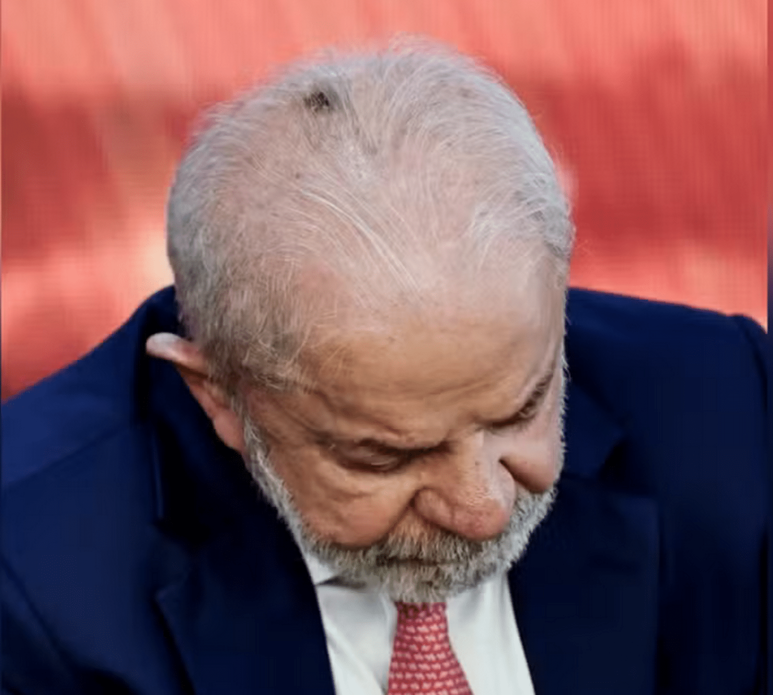 Lula tem alta após procedimentos para tirar lesão do couro cabeludo e tratar tendinite