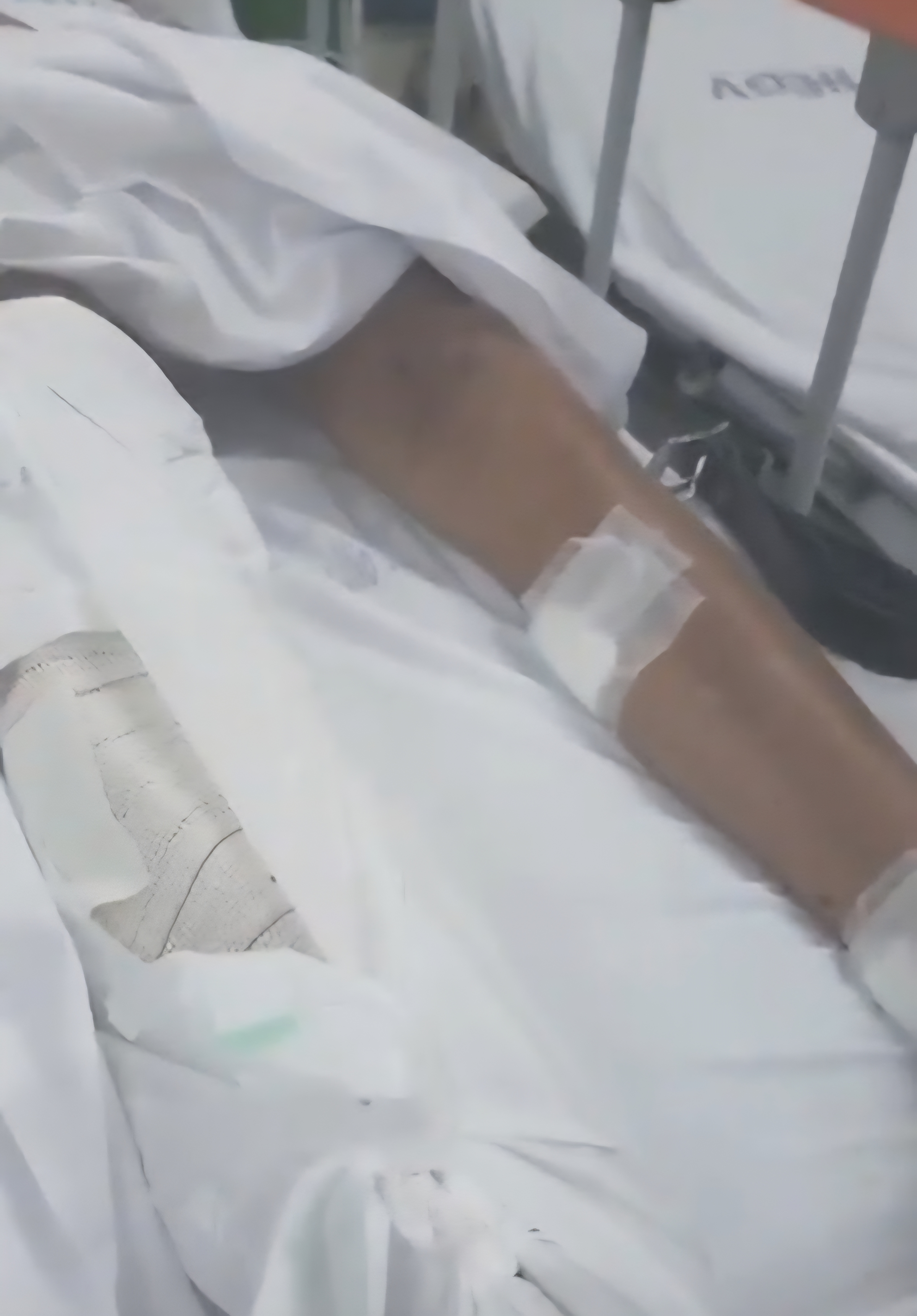 Adolescente fica ferido após ser atingido por granada em Brás de Pina; família diz que explosivo foi lançado por drone