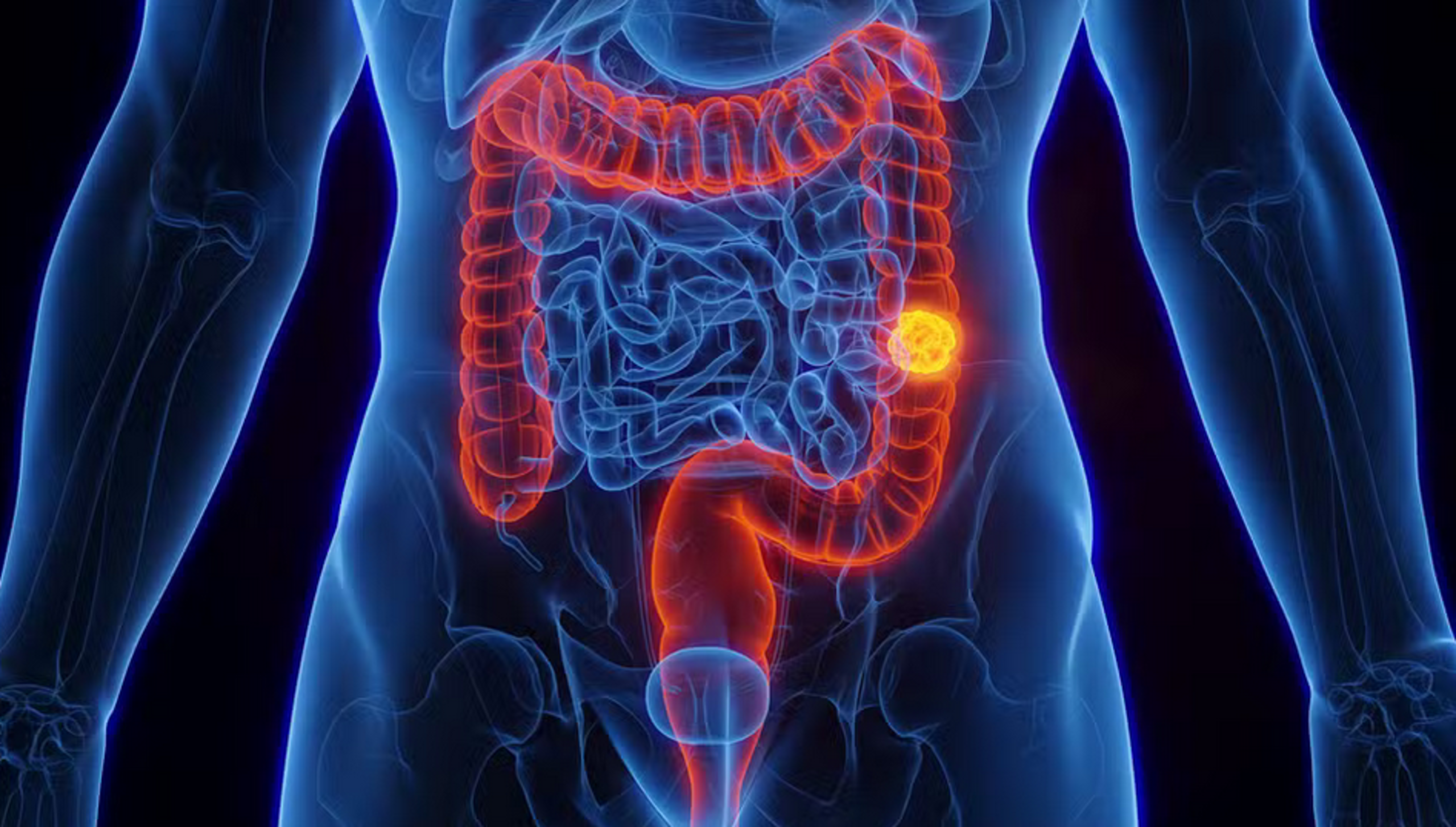 SUS adota novo protocolo com exame que detecta câncer de intestino antes dos sintomas