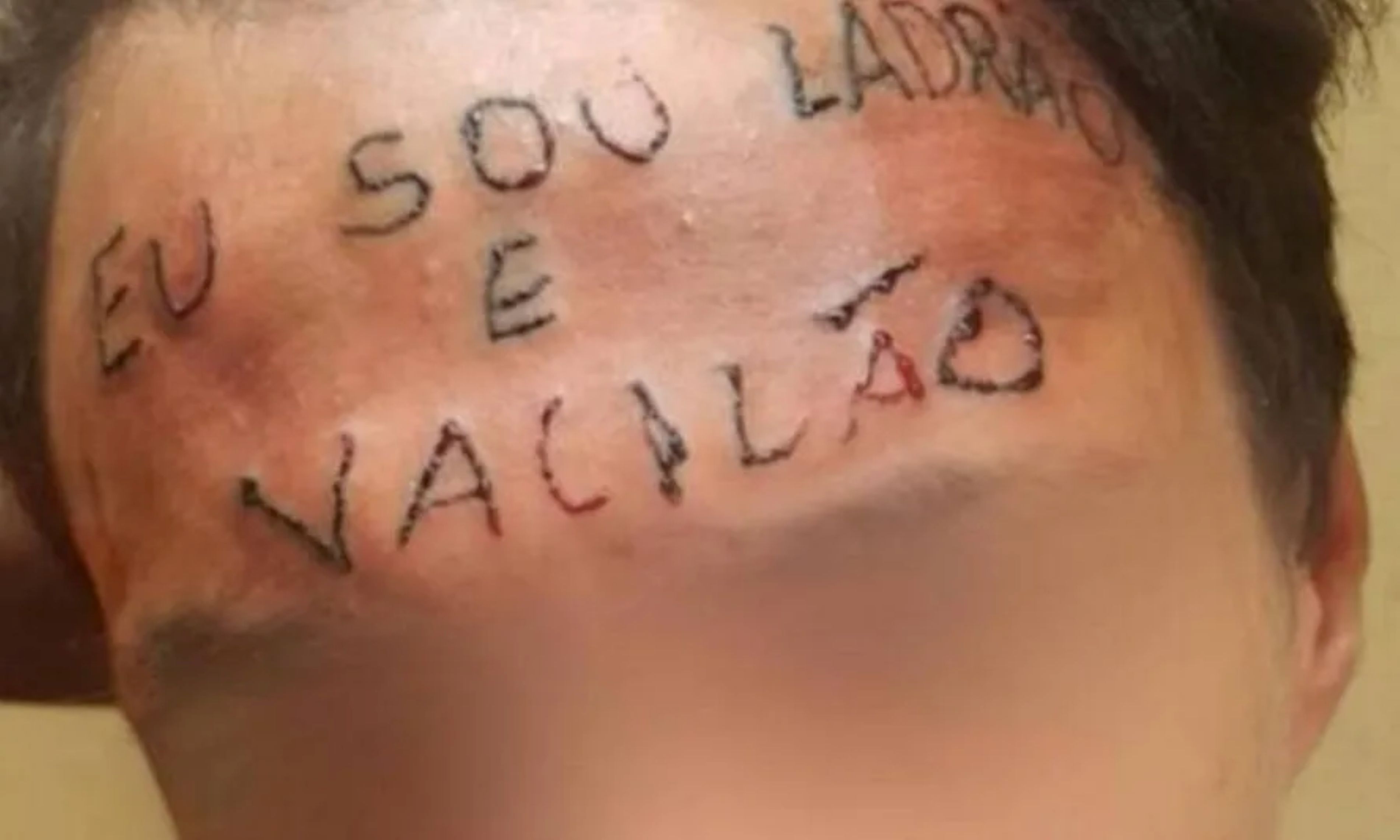 Jovem que teve testa tatuada à força é condenado por furto em UBS de Diadema